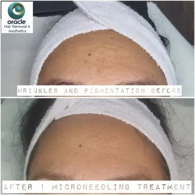 Fab results after 1 Microneedling Treatment 😍😍Collagen Booster ✔️
Wrinkle Reduction ✔️
Sun Damage repair ✔️
Acne scar repair ✔️