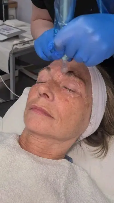 Medical Microneedling with the AMIEAMED Exceed 😍
⭐️Collagen Booster⭐️Acne Scar repair 
⭐️Tightens skin 
⭐️Wrinkle repair
⭐️Bring back that Glow ❤️