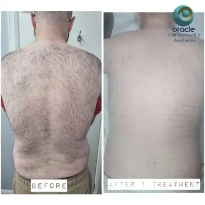 We love getting stuck into a full back for laser hair removal and I love these results even more 🥰🥰
Superb,1 treatment down and Valentines Day next week😉!! Fab 👏👏