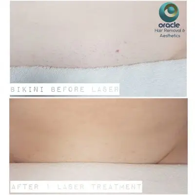 Bikini Line looking fab and Summer on the Horizon 😍☀️Photos are before and after 1 Treatment  and you can already see a reduction in ingrown hairs 🙌🙌