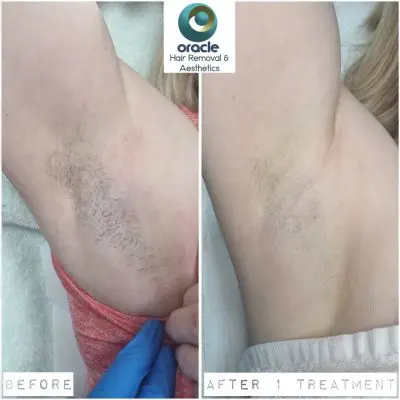 Underarm progress after 1 Treatment 😍Love it ❤️ great progress so far 👏 
Underarms are normally the entry point for our clients' hair removal journey. Once results like this are seen, there's no stopping, it's onwards and upwards to bikini... legs... 🙌
